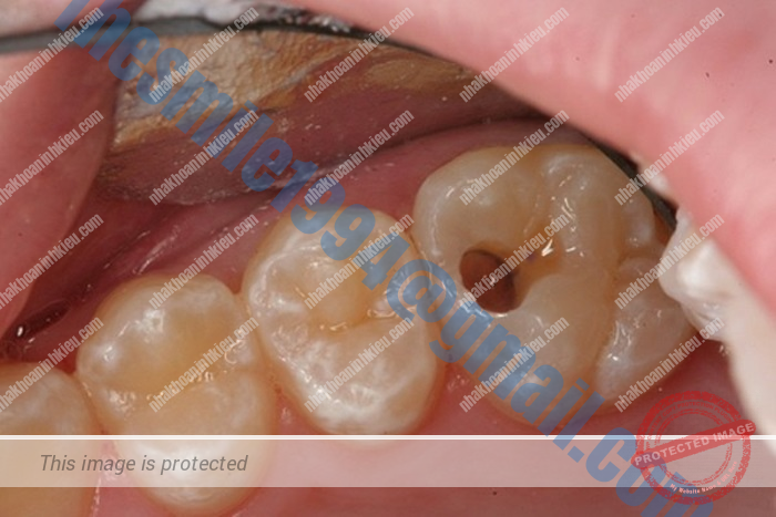 sâu răng tạo lỗ thủng
